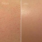 Strawberry skin treatment