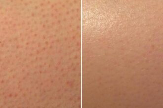 Strawberry skin treatment