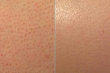 Strawberry skin treatment