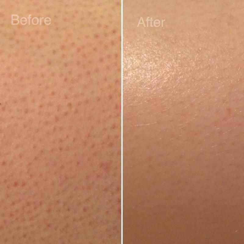 Strawberry skin treatment